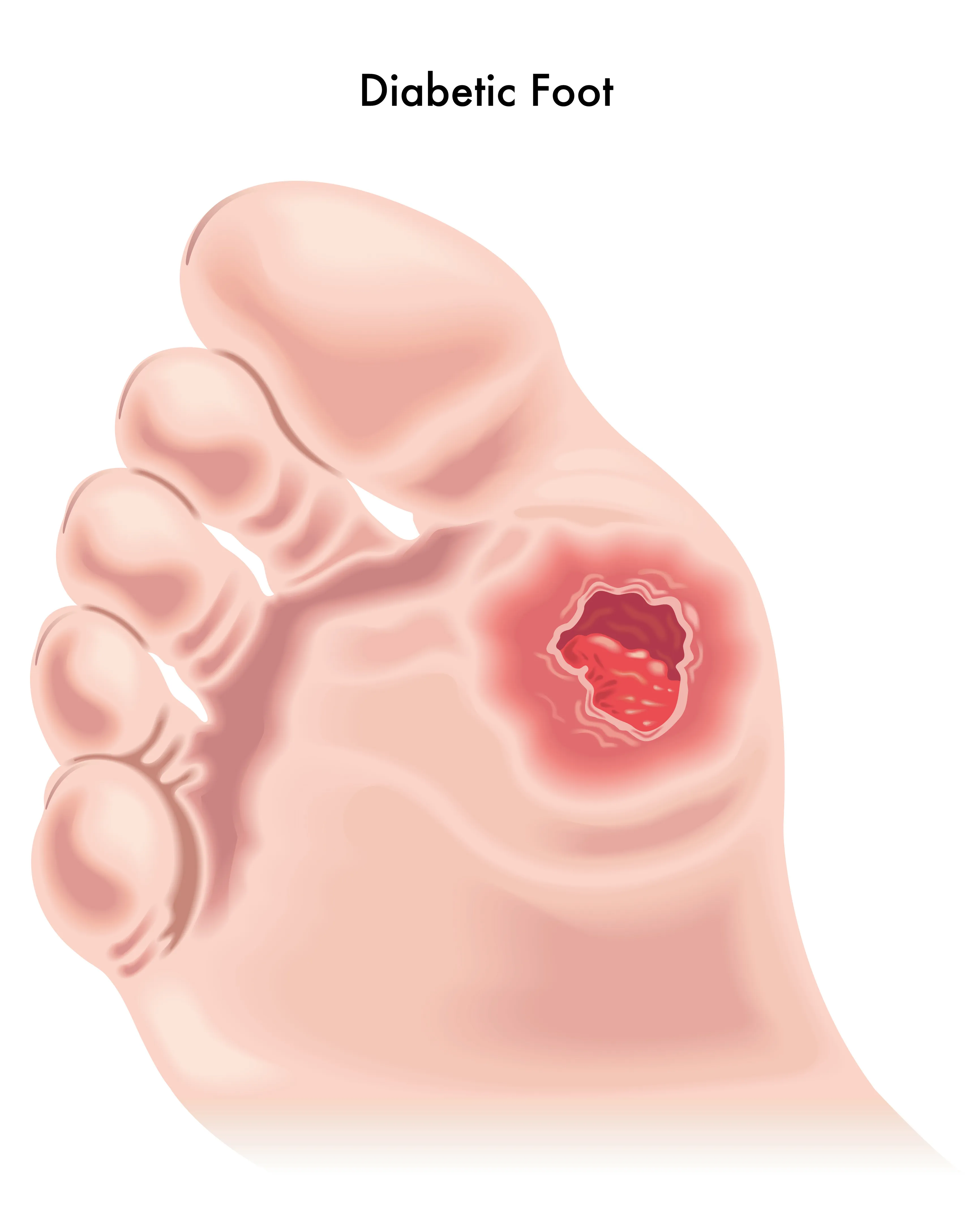 Illustration of a diabetic foot wound on the sole of a foot