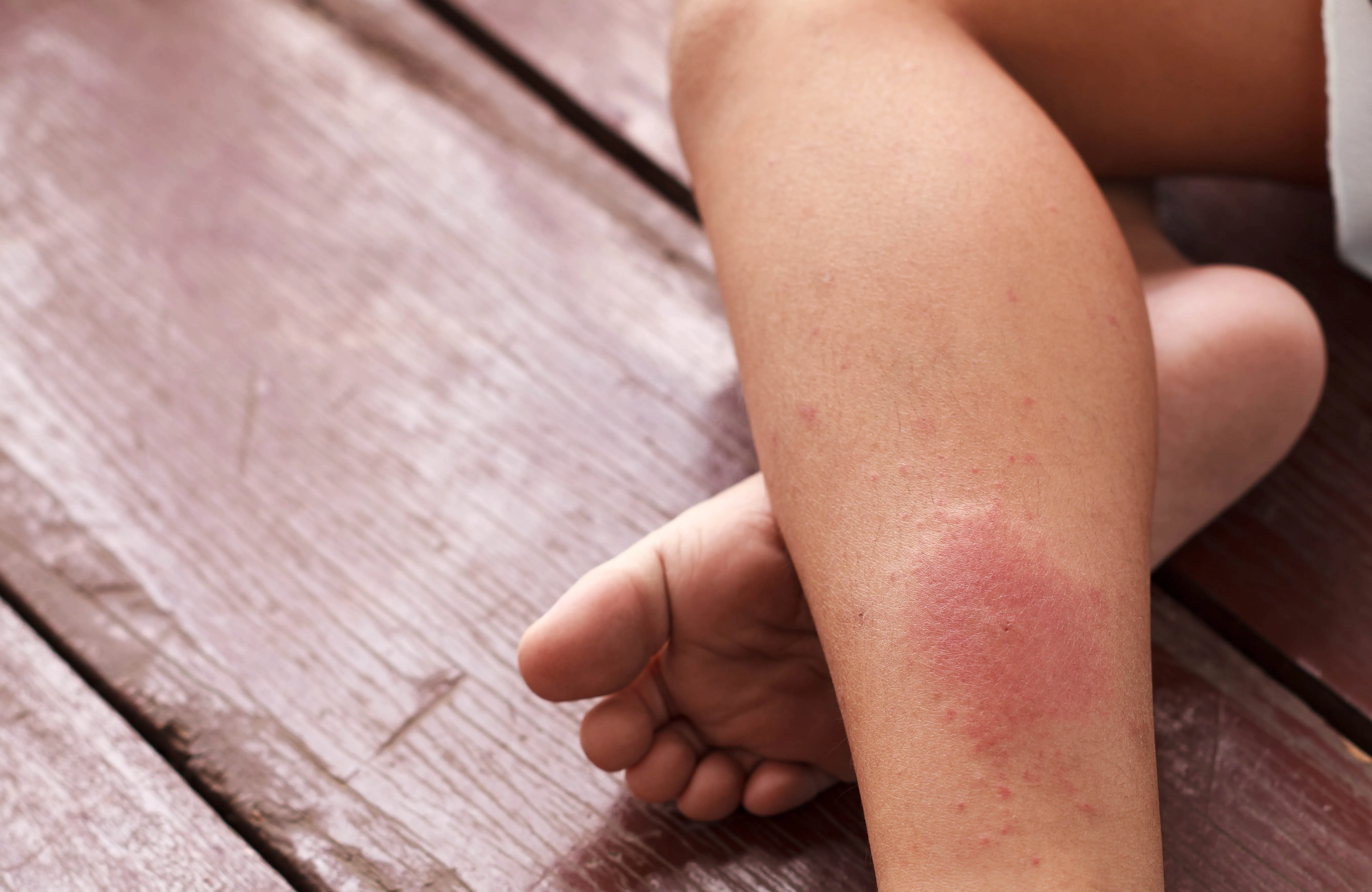 Photograph of a venous leg wound showing skin irritation on the lower leg